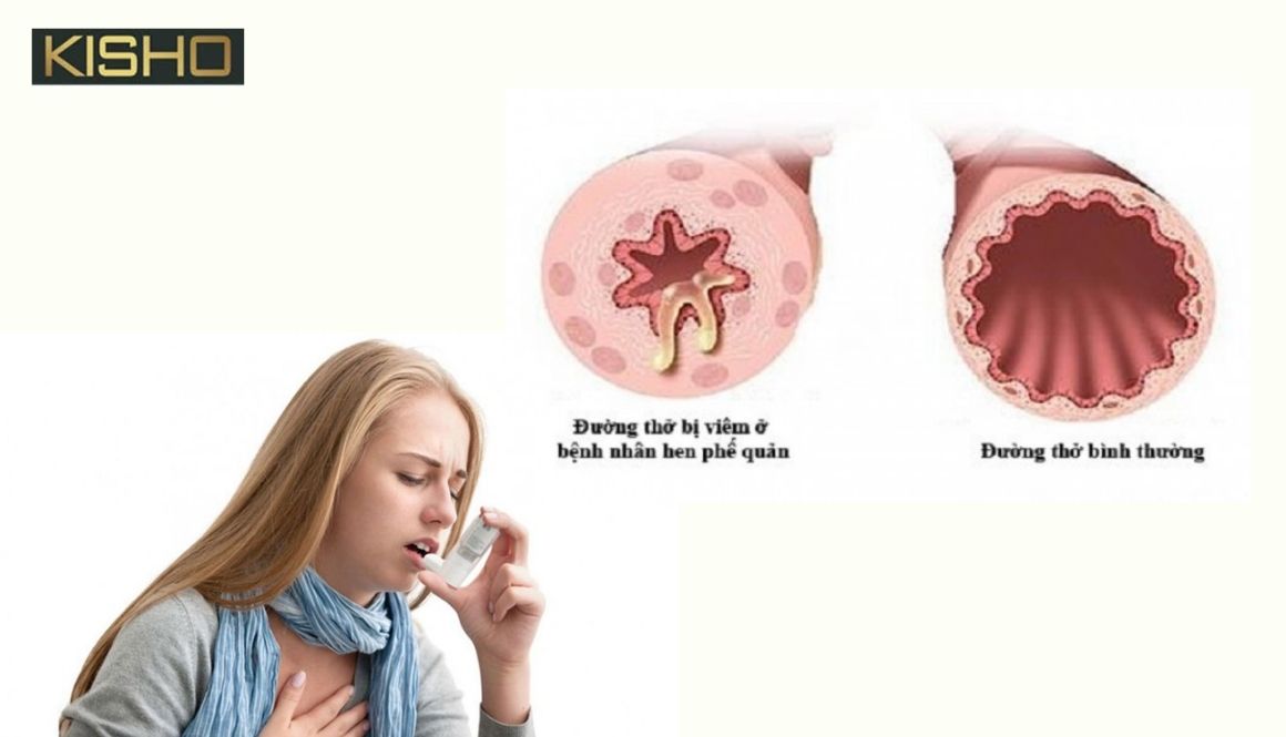 bệnh hen phế quản có lây không?