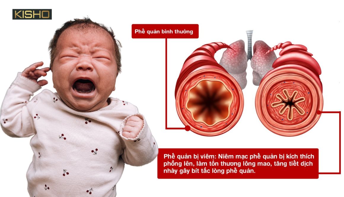 bieu-hien-viem-phe-quan-tre-so-sinh-ba-me-can-luu-y