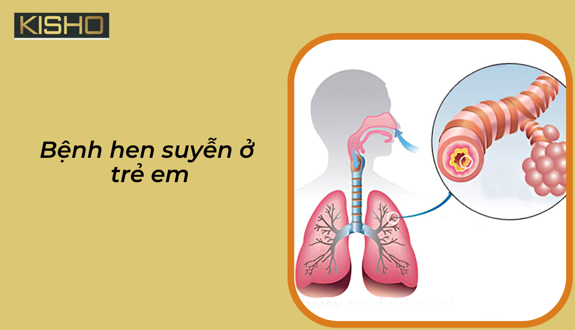 Bệnh hen suyễn ở trẻ em nguyên nhân từ đâu?
